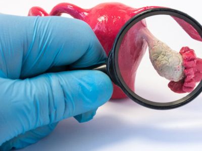 Σύνδρομο πολυκυστικών ωοθηκών: Οι επιπτώσεις στην ψυχική υγεία (εικόνες)