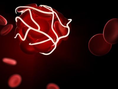 Θρόμβος στο αίμα: 7 σιωπηλά σημάδια που πρέπει να γνωρίζετε (εικόνες)