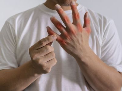 Ουρική αρθρίτιδα: Τι περιλαμβάνει η διατροφή για την πρόληψη & την αντιμετώπισή της (εικόνες)