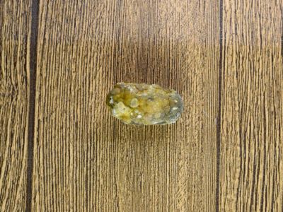 Πέτρες στη χολή: Ποιοι κινδυνεύουν περισσότερο (εικόνες)