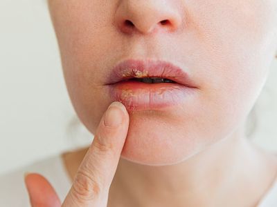 Επιχείλιος έρπης: Φυσικοί τρόποι αντιμετώπισης (εικόνες)