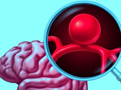 Ανεύρυσμα: Οι κύριες αιτίες ρήξης (εικόνες)