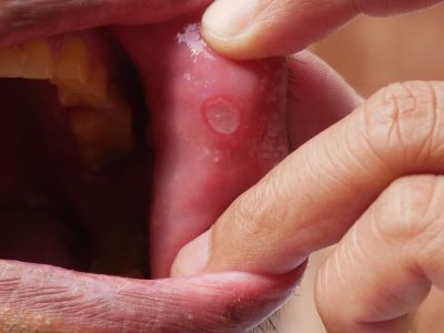 Έλκη στο στόμα: Πού μπορεί να οφείλονται (εικόνες)