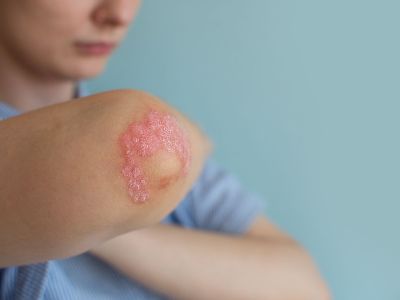 Ψωριασική αρθρίτιδα: Οι παράγοντες που αυξάνουν τον κίνδυνο (εικόνες)