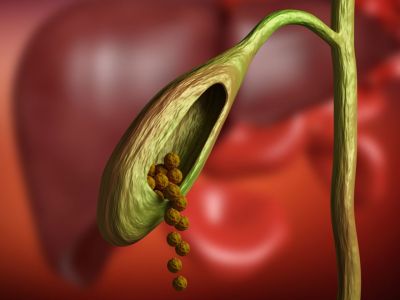 Χολολιθίαση: Ποιοι κινδυνεύουν περισσότερο από πέτρες στη χολή (εικόνες)