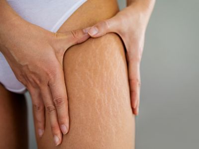 Κυτταρίτιδα: Σπιτικά καλλυντικά και ασκήσεις για να τη μειώσετε πριν το καλοκαίρι