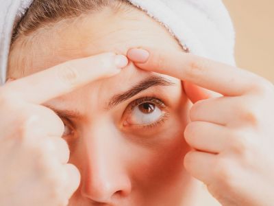 Ακμή ενηλίκων - Τι πρέπει να γνωρίζει μια αγχωμένη μαμά