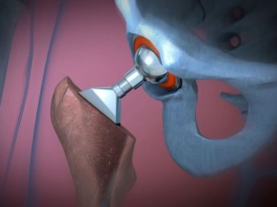 Μετεμμηνόπαυση και κάταγμα ισχίου: Οι βιταμίνες που αυξάνουν τον κίνδυνο