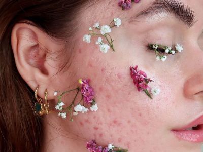 8 τροφές για να καταπολεμήσεις τα σπυράκια