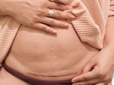 «Βλέπεις αυτό το σημάδι; Είναι το καλύτερο που απέκτησα ποτέ»