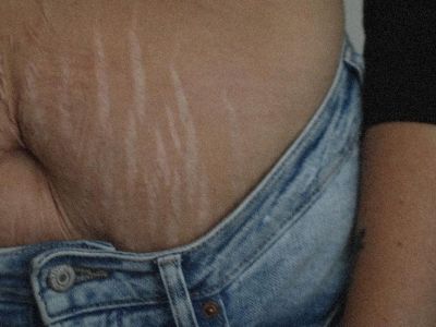 «Νιώθω ευγνωμοσύνη για τις ραγάδες μου»