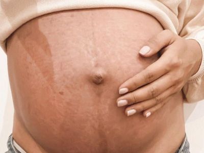 «Αγαπημένες μαμάδες που γεννήσατε με καισαρική σταματήστε να νιώθετε ενοχές»