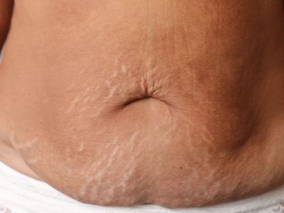 Δείξε τις ραγάδες σου με περηφάνια