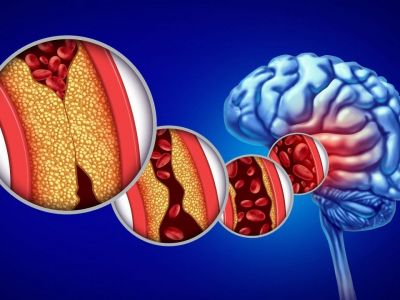 Χοληστερίνη: Γιατί δεν βλάπτει μόνο την καρδιά, αλλά και τον εγκέφαλο