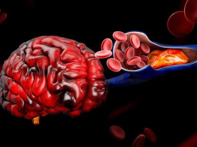 Θρόμβωση: Ποιοι άνθρωποι αντιμετωπίζουν πολλαπλάσιο κίνδυνο