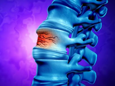 Οστεοπορωτικό κάταγμα: Ποιοι ανήκουν στην κατηγορία υψηλού κινδύνου