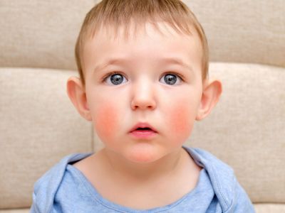 Πέμπτη νόσος ή σύνδρομο κόκκινων παρειών: Τι πρέπει να γνωρίζετε