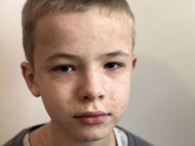 Ιλαρά: Οδηγός πρόληψης για γονείς