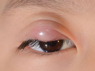 Το παιδί μου έχει κριθαράκι στο μάτι -Τι πρέπει να κάνω;