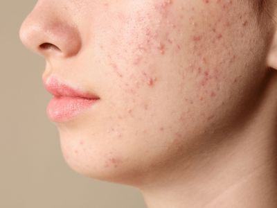 Καλοκαιρινή έξαρση ακμής σε έφηβους: Αιτίες και πρακτικές λύσεις