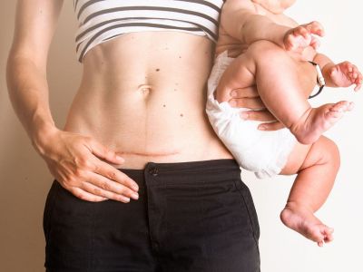 Τι πραγματικά συμβαίνει κατά τη διάρκεια μιας καισαρικής τομής – και πόση ώρα διαρκεί