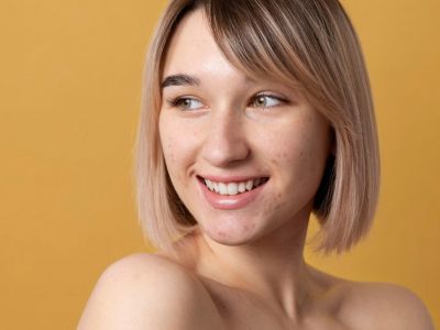 Ακμή στο πρόσωπο: Η ολοκληρωμένη ρουτίνα για καθαρή και λεία επιδερμίδα