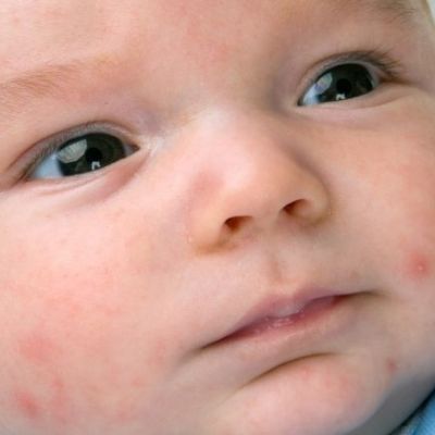 Βοήθεια! Το μωρό μου έχει ακμή!