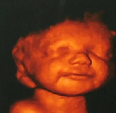 Είδε το αγέννητο μωρό της να χαμογελά και δεν έκανε έκτρωση