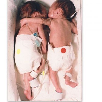 Oταν η μικροσκοπική αγκαλιά της, έσωσε τη ζωή της δίδυμης αδερφής της