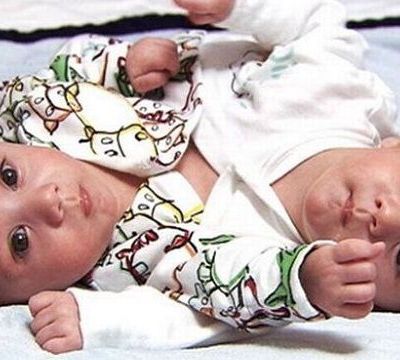 Τα σιαμαία που κέρδισαν τη ζωή και τώρα πηγαίνουν σχολείο! (φωτογραφίες)