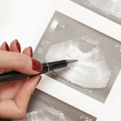 Σύνδρομο πολυκυστικών ωοθηκών: Αίτια & συμπτώματα