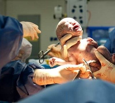 Όλα όσα θέλετε να ξέρετε για την καισαρική τομή, από τον γυναικολόγο του Mothersblog!