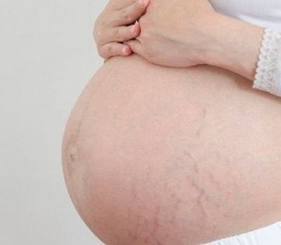 Ραγάδες στην εγκυμοσύνη: Τι είναι; Πώς αντιμετωπίζονται; (βίντεο)