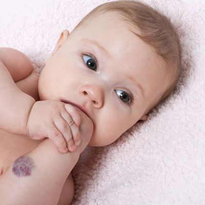 Αιμαγγειώματα παιδικής ηλικίας: Όλα όσα πρέπει να γνωρίζετε