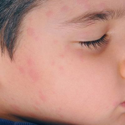 Τρόποι προστασίας των παιδιών στην έξαρση ιλαράς