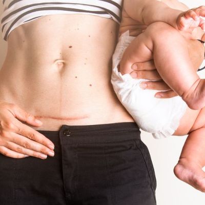 Επηρεάζει η καισαρική τομή την ανθρώπινη εξέλιξη; (vid)