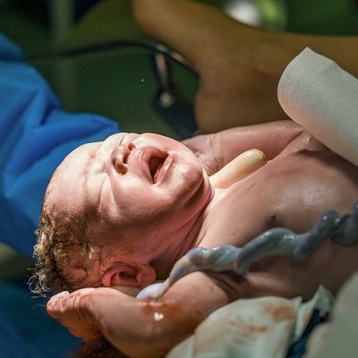 Τι είναι οι κύστεις του ομφαλίου λώρου