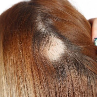 Γυροειδής Αλωπεκία: Πώς επηρεάζει την ψυχολογία;