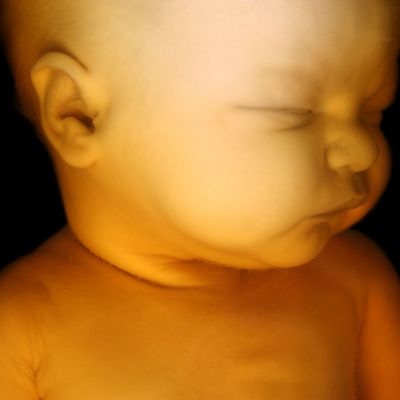 Πόσο συχνό είναι το φαινόμενο της αποβολής