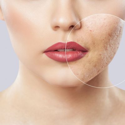 Ακμή στην εγκυμοσύνη: Γιατί συμβαίνει και πώς να απαλλαγείτε