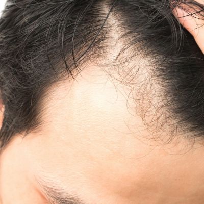 Γιατί οι άνδρες υποφέρουν από τριχόπτωση;