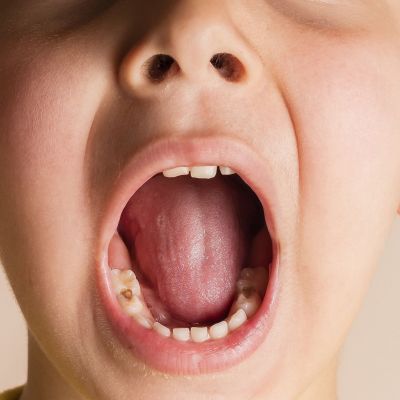 3 βασικά σημάδια της πρώιμης παιδικής τερηδόνας