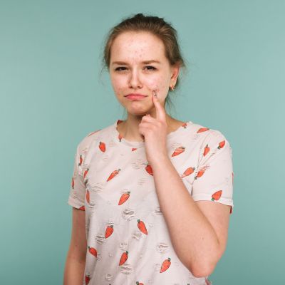 Ακμή στην εφηβεία: Εμφανίζεται στην ίδια ηλικία σε αγόρια και κορίτσια;