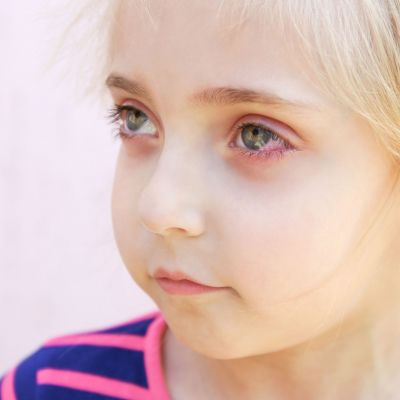 Επιπεφυκίτιδα στα παιδιά και πυρετός - Τι πρέπει να γνωρίζετε