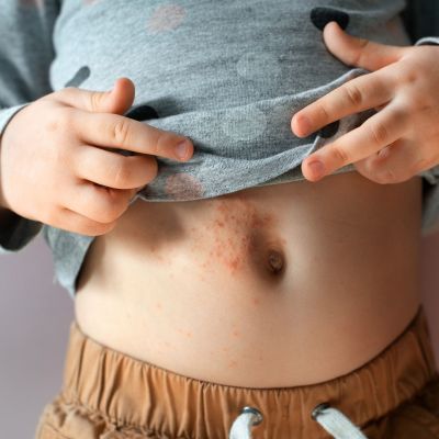 «Συναγερμός» για τον στρεπτόκοκκο και την ευλογιά των πιθήκων - Τι να προσέχουν οι γονείς