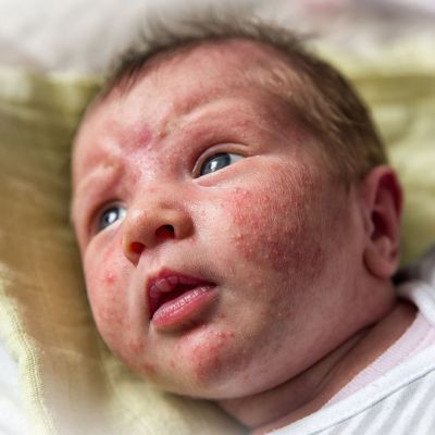 Βρεφική ακμή: Αίτια και αντιμετώπιση