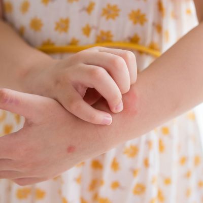 Εξανθήματα στα παιδιά: Πώς θα καταλάβετε αν είναι σοβαρά