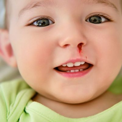 Γιατί ματώνει η μύτη του παιδιού στον ύπνο;