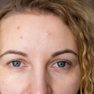 Ακμή ενηλίκων: 7 αιτίες που δεν γνωρίζετε και τρόποι αντιμετώπισης