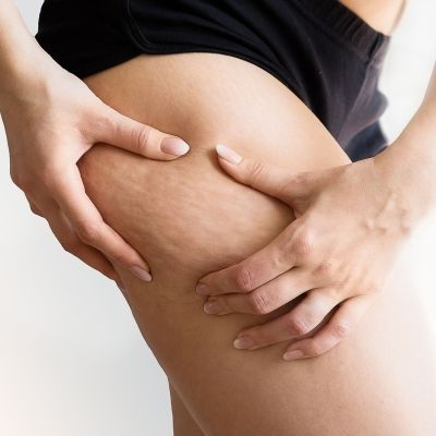 Καστορέλαιο για τη μείωση της κυτταρίτιδας: Πώς να το χρησιμοποιήσετε